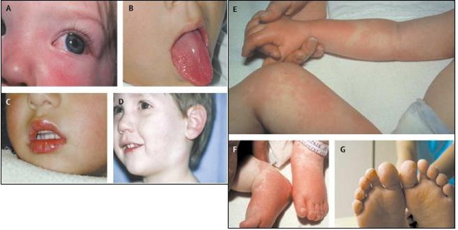 Karakteristike Kavasaki bolesti