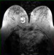 Filodes tumor dojke na snimku magnetnom rezonancom