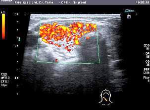Ultrazvuk Štitaste žlijezde
