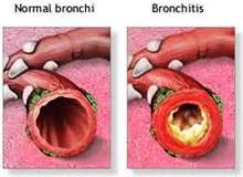 Hronicni bronhitis