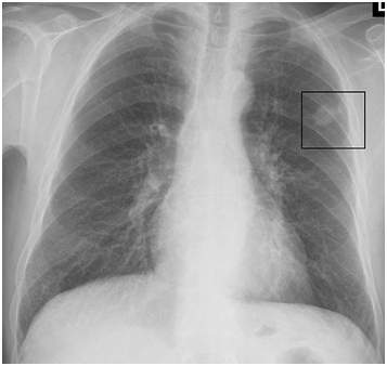 Radiografija pluca 