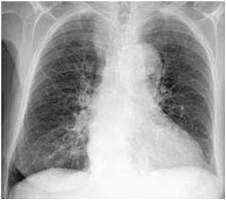 Rentgenski snimak hronicnog bronhitisa