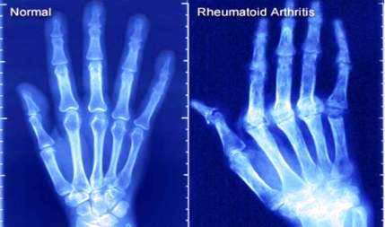 Reumatoidni artritis 