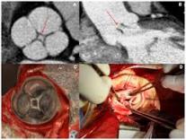 Aortna insuficijencija